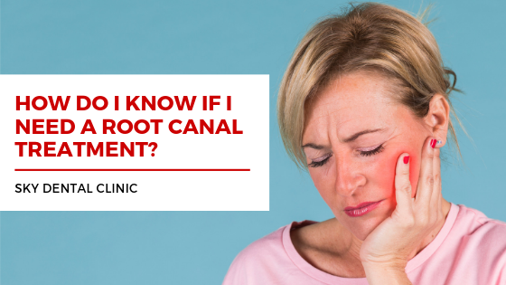 Symptoms of Root Canal Treatment