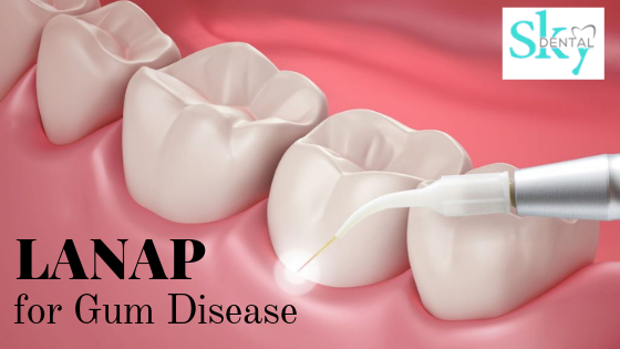 LANAP treatment for gum disease
