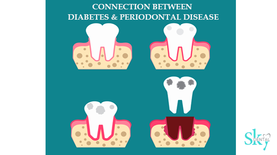Connection between Gum disease and daibetes