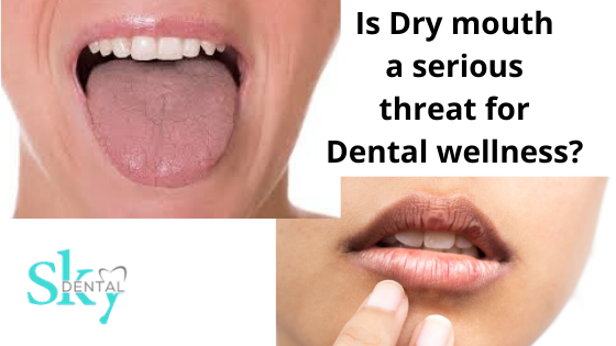 Is dry mouth a serious threat for dental wellness?