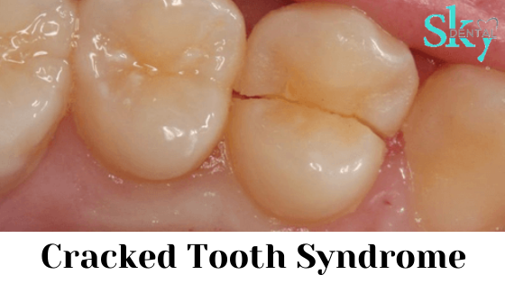 Cracked tooth syndrome