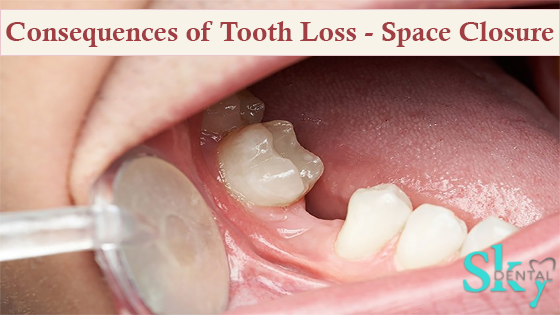 Consequences of Tooth Loss