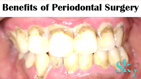 benefits of periodontal surgery