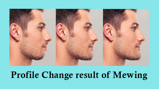 Mewing Side Profile Results - Before/Afters 