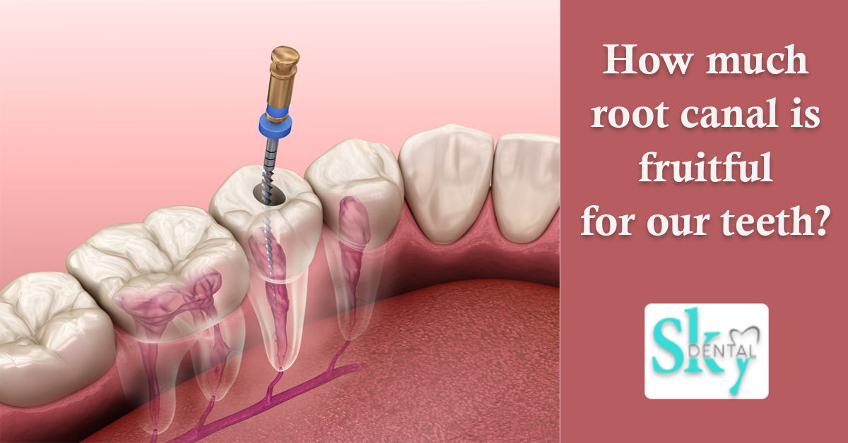 How much root canal is fruitful for our teeth? Is there any side effect of it?