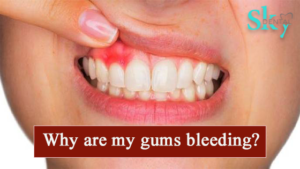 Why are my gums bleeding?