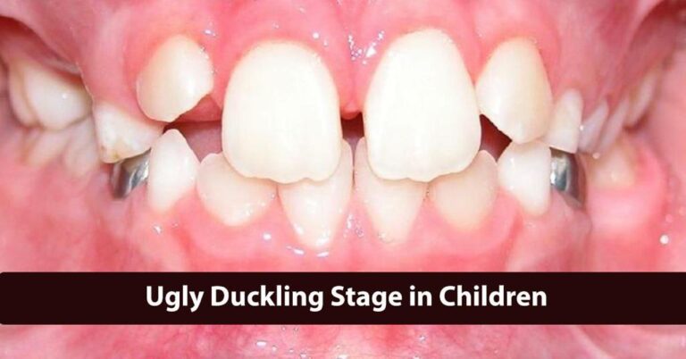 Ugly Duckling Stage In Children- Sky Dental Care Hospital