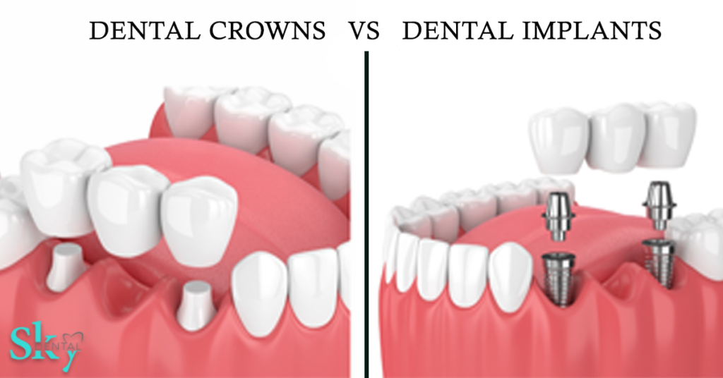 dental crowns vs dental impants