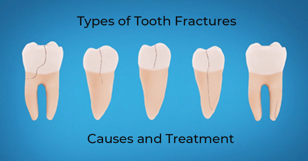 Tooth Fracture Causes And Treatment Sky Dental Care