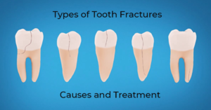 tooth fracture