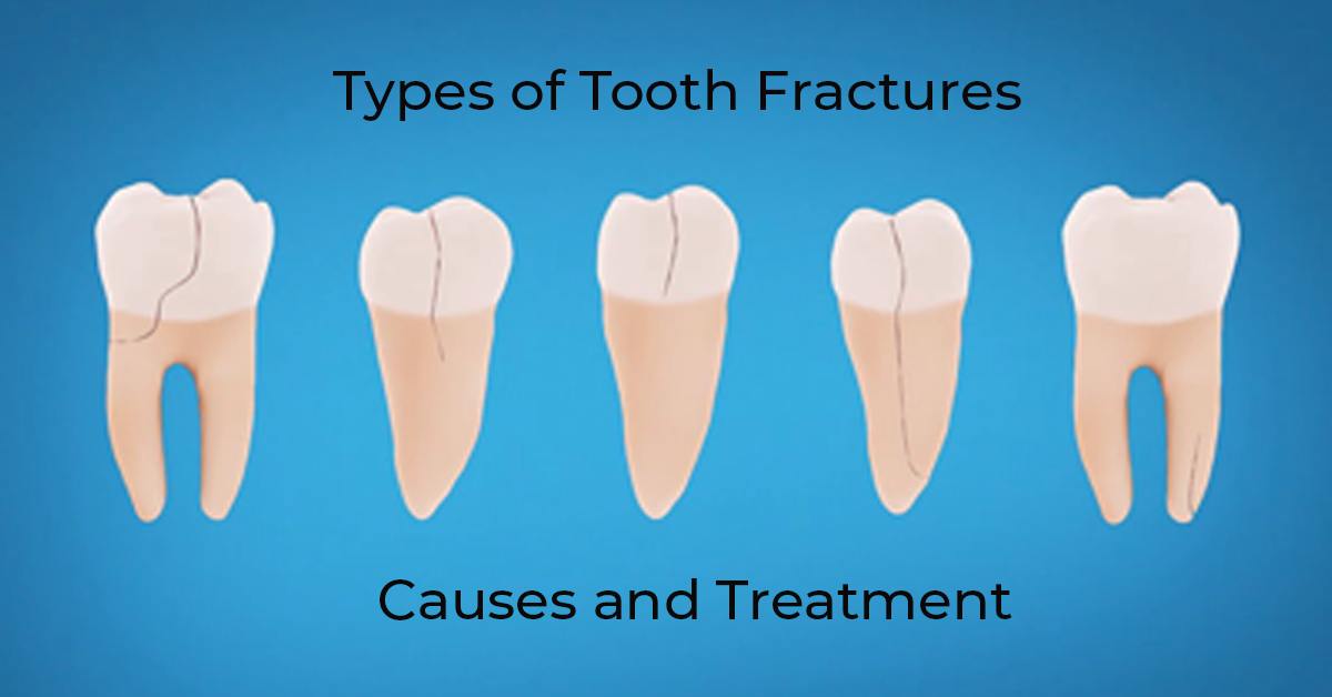 Tooth Fracture Nhs