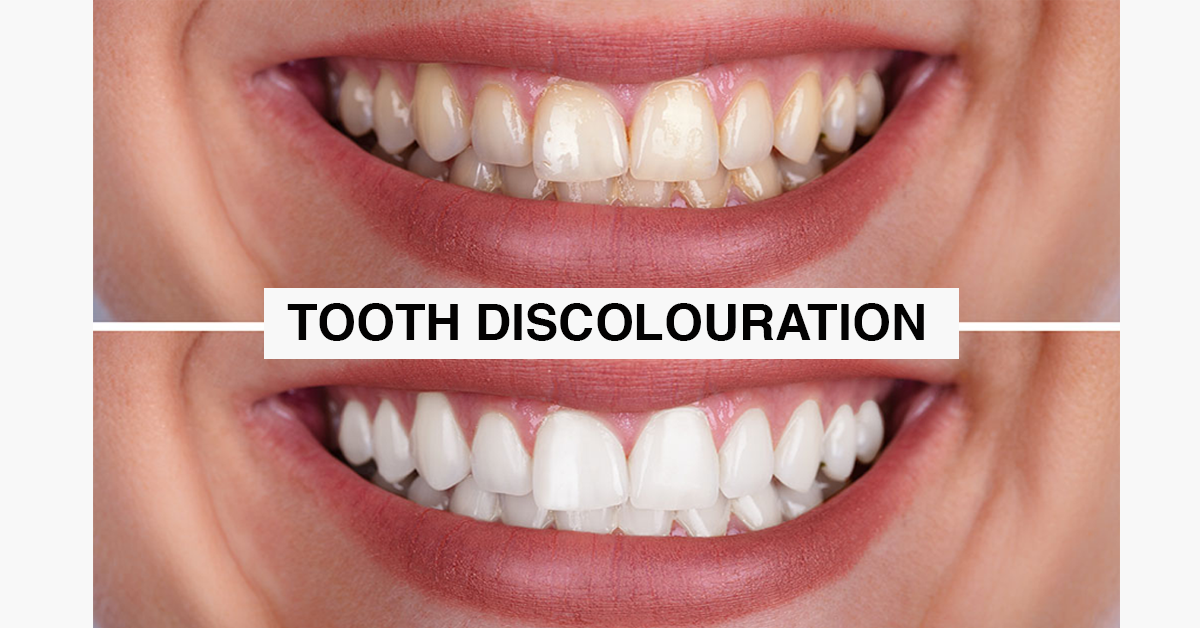 Tooth Discolouration Prevention And Treatment Sky Dental Care