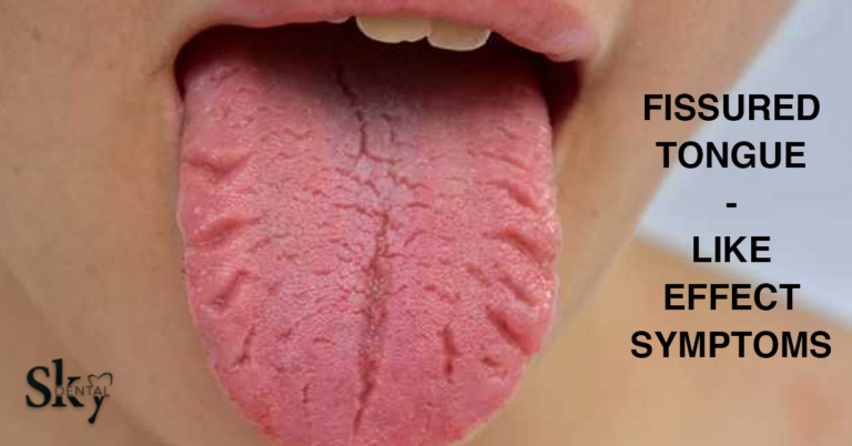 Fissured Tongue Symptoms Sky Dental Care Hospital   Untitled 1 768x402 