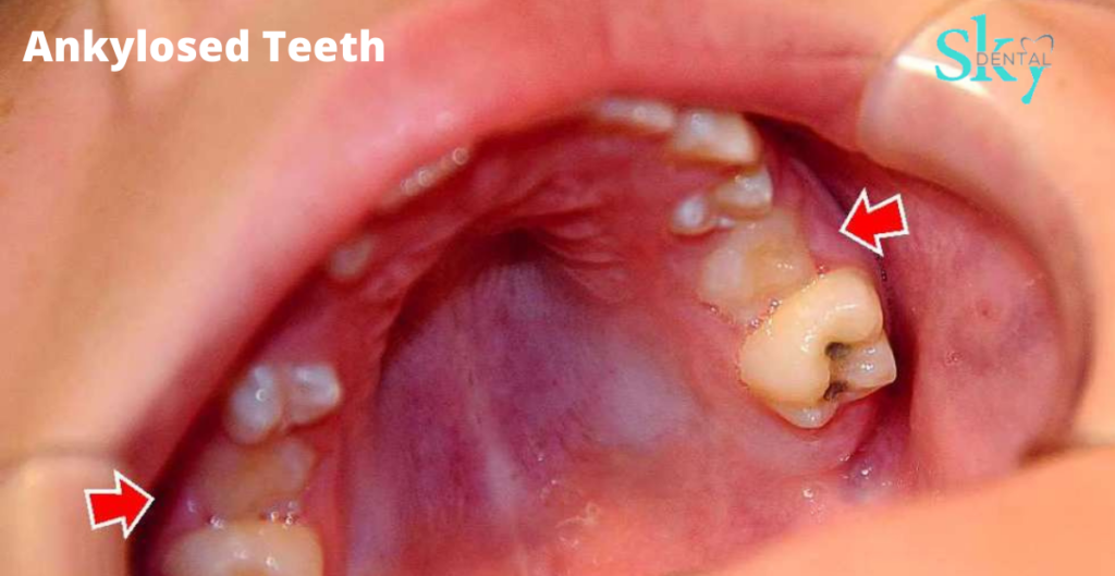 ankylosed tooth