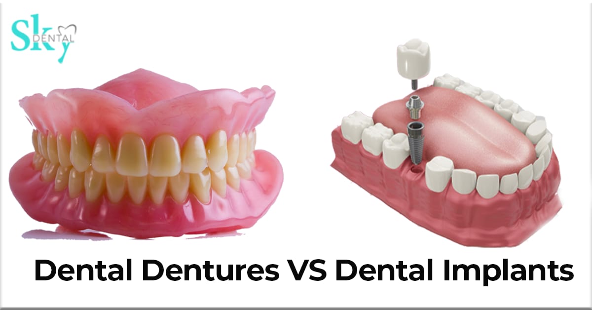 About Dental Dentures and Dental Implants - Sky Dental Vijayawada