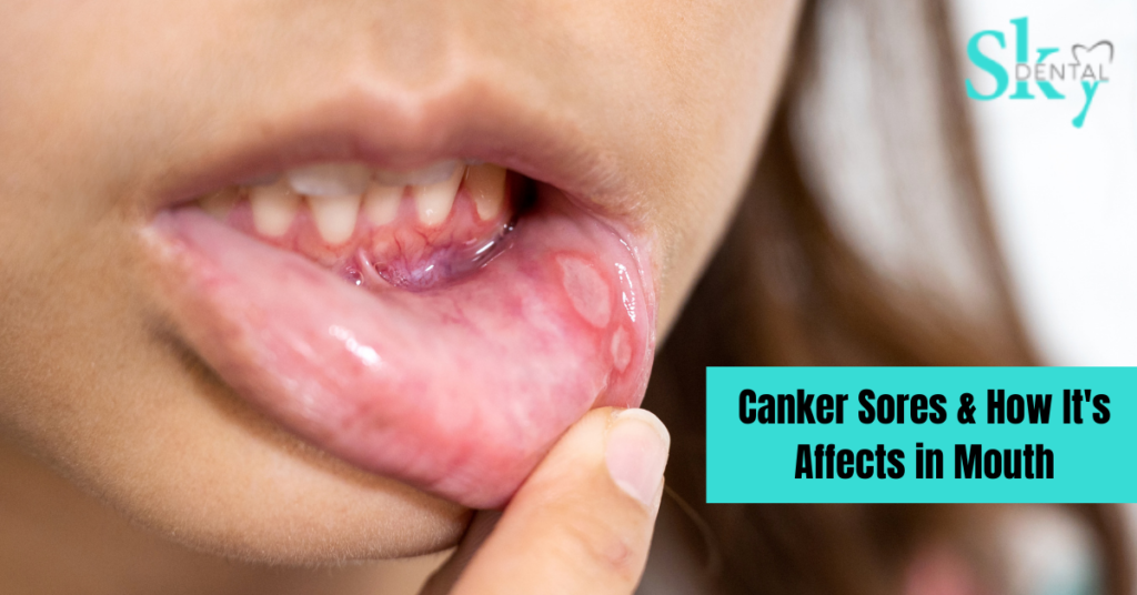Canker Sores & How It's Affects in Mouth