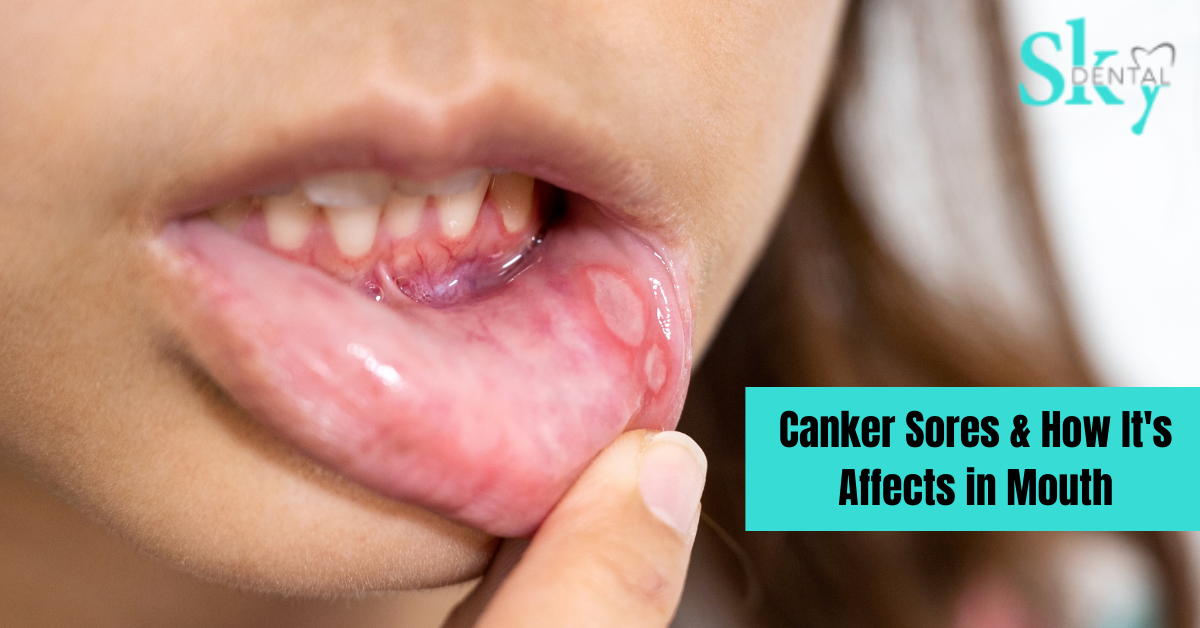 canker-sores-it-s-affects-in-mouth-sky-dental-vijayawada