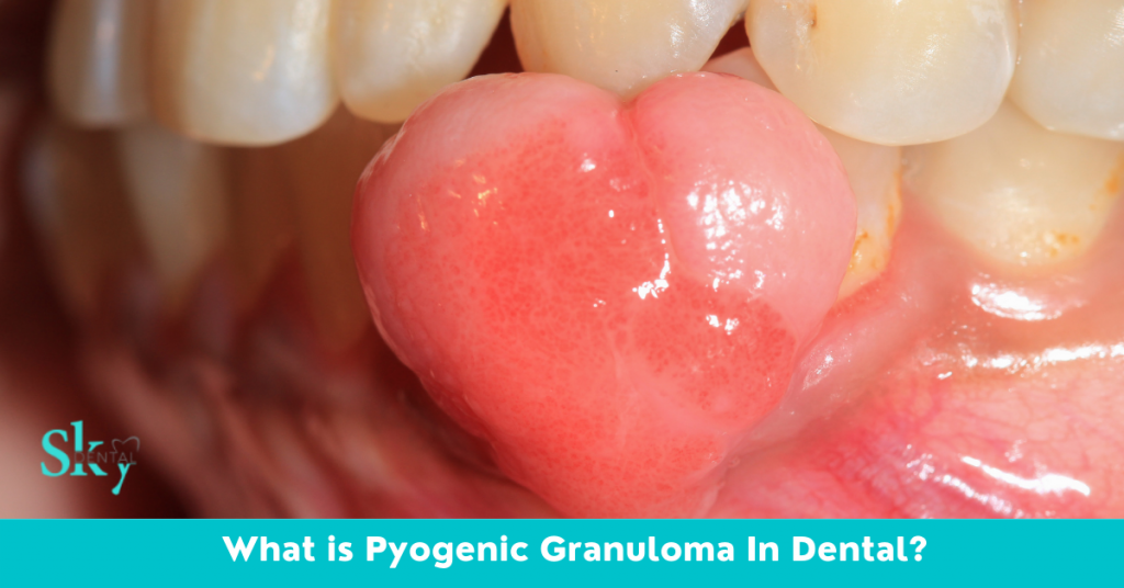 What is Pyogenic Granuloma In Dental