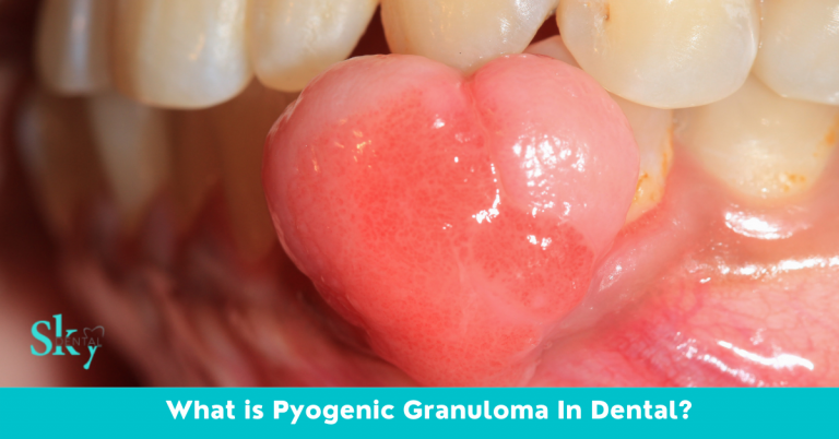 Pyogenic Granuloma In Dental Sky Dental Vijayawada