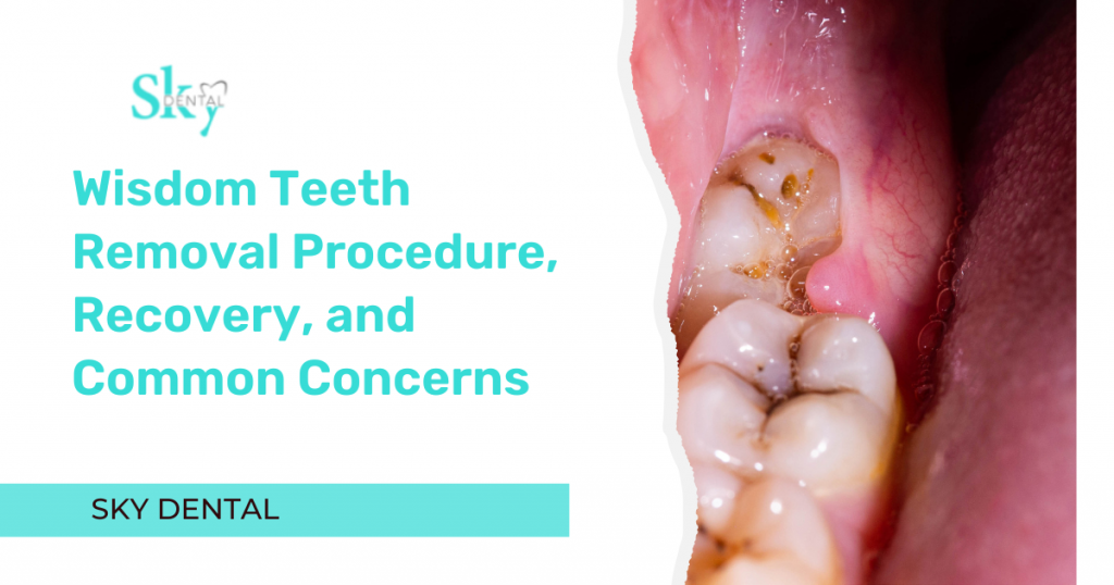 Wisdom Teeth Removal Procedure, Recovery, and Common Concerns