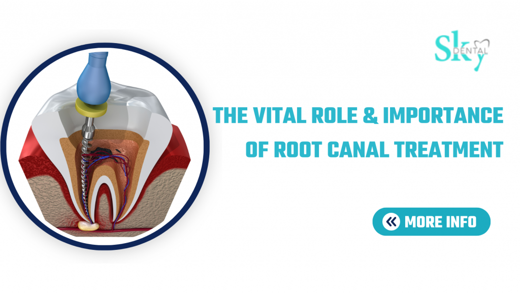 The Vital Role & importance of Root Canal Treatment