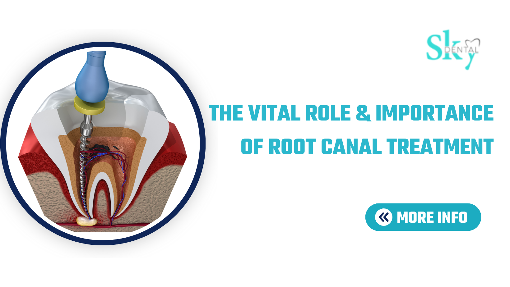 Importance of Root Canal Treatment By sky Dental