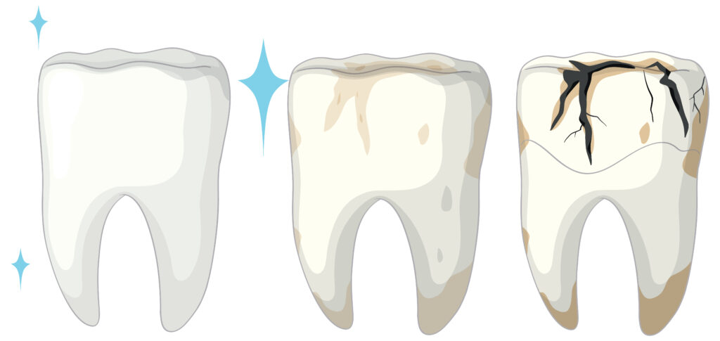 fluoridation impacts dental decay