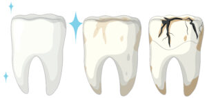 fluoridation impacts dental decay