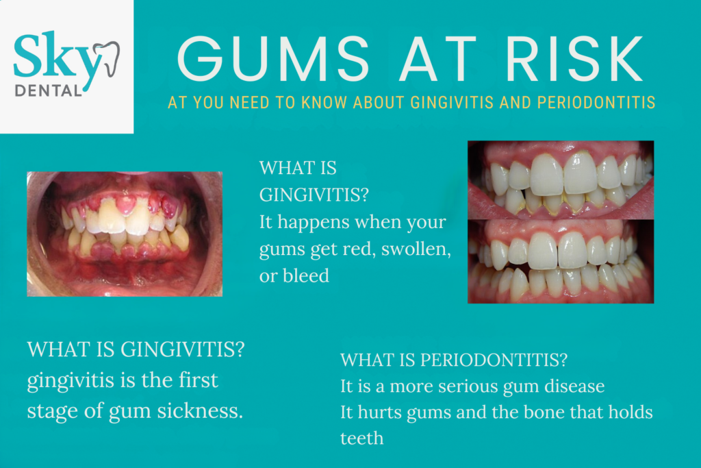 Gums at Risk: What You Need to Know About Gingivitis and Periodontitis