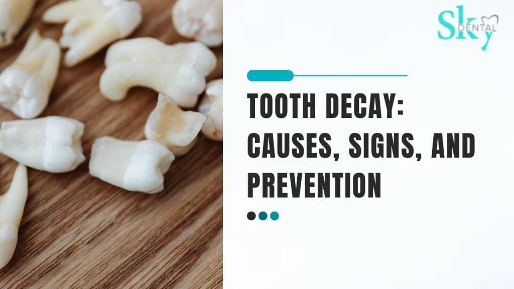 What is tooth decay and how to prevent it?