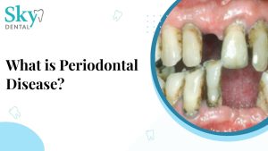 How to Prevent Periodontal Disease