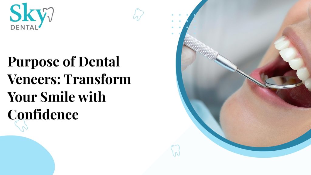 dental veneers