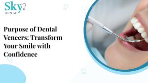 dental veneers