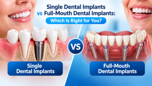 Single Dental Implants vs Full-Mouth Dental Implants